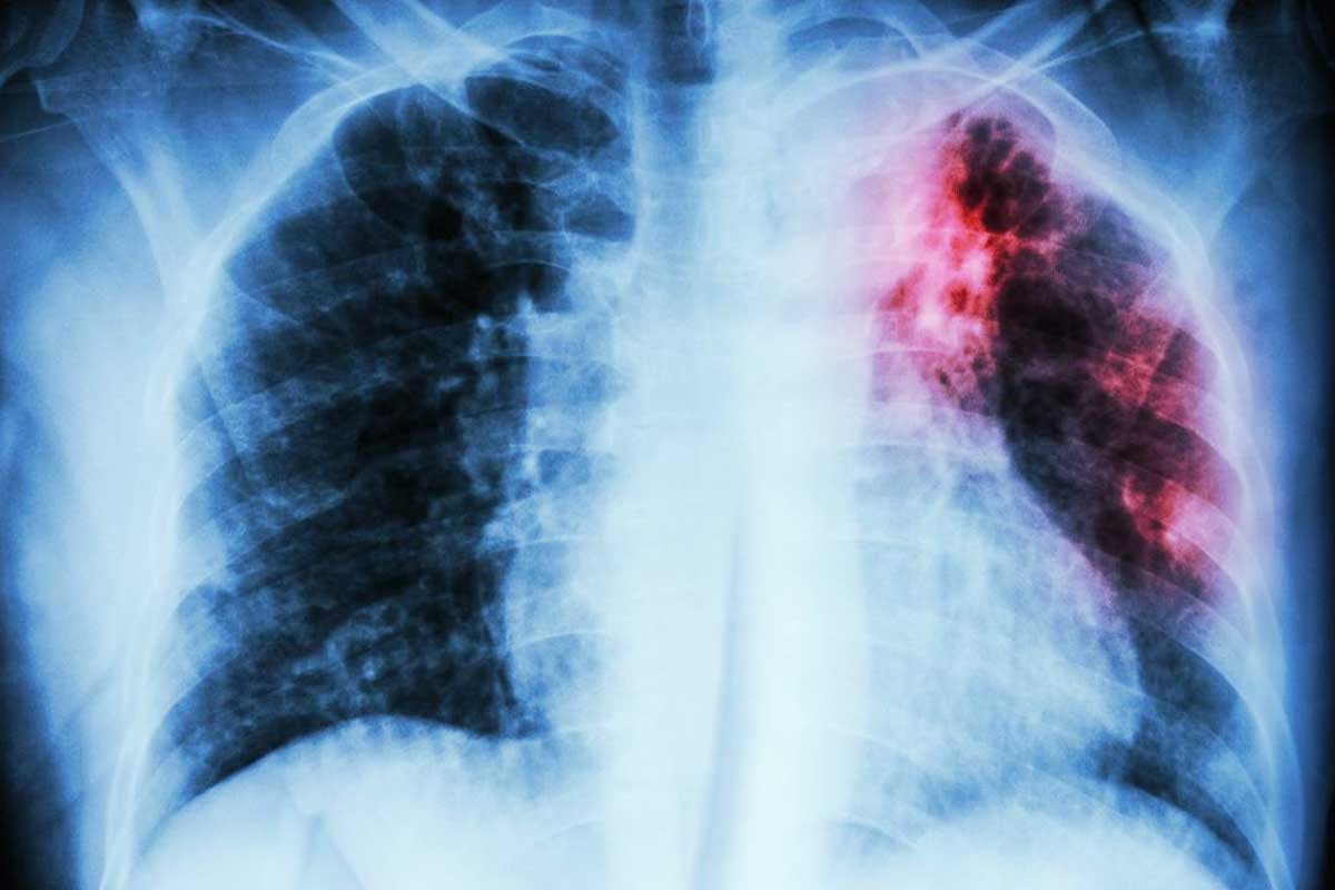 Waiting For Test Results Can Be Agonizing, TB Patients Lament As They Get Sidelined Due To COVID-19 Pandemic